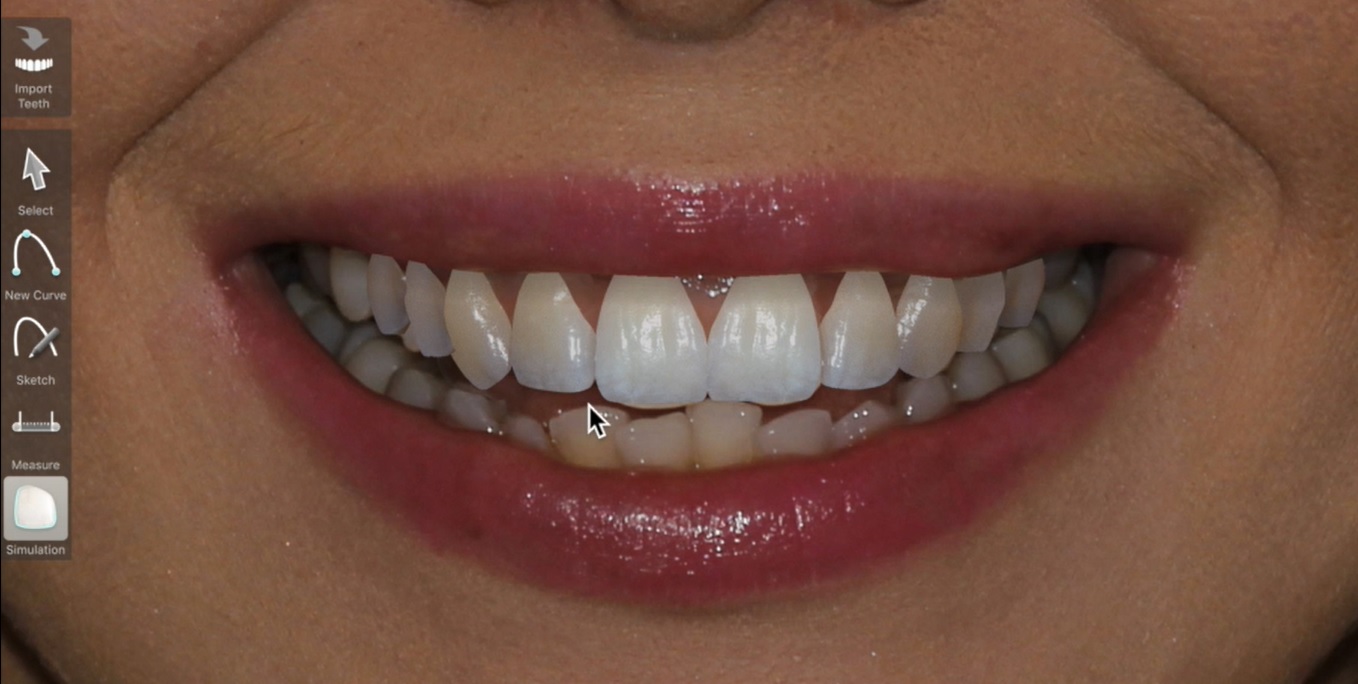 Dijital Gülüş Tasarımı Dijital Gülüş Tasarımı